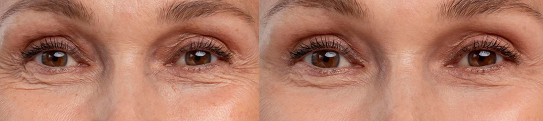 Can Red-Light Therapy Improve Wrinkles, Puffiness, and Dark Circles Around the Eyes?