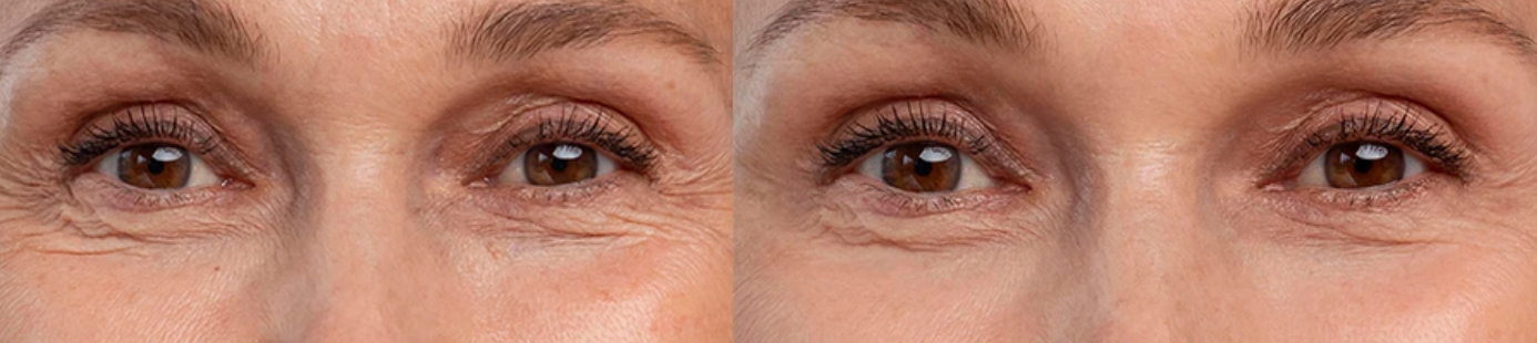 Can Red-Light Therapy Improve Wrinkles, Puffiness, and Dark Circles Around the Eyes?