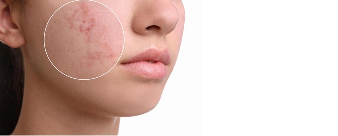 Can Red-Light Therapy help Fade Acne Scars?