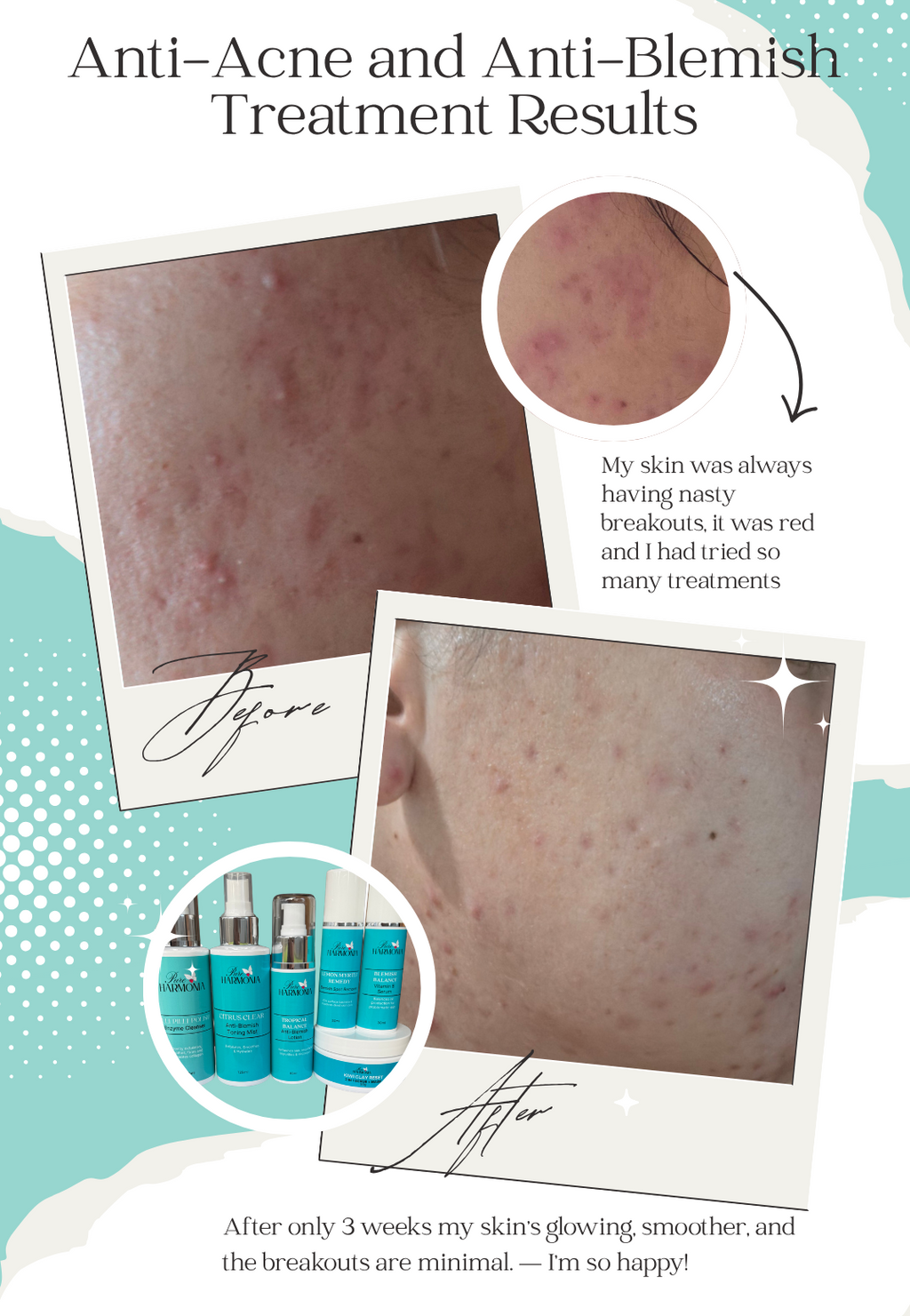 ESSENTIALS PACK - Acne and Blemish-Prone Skin Collection lifestyle detail - Pure Harmonia