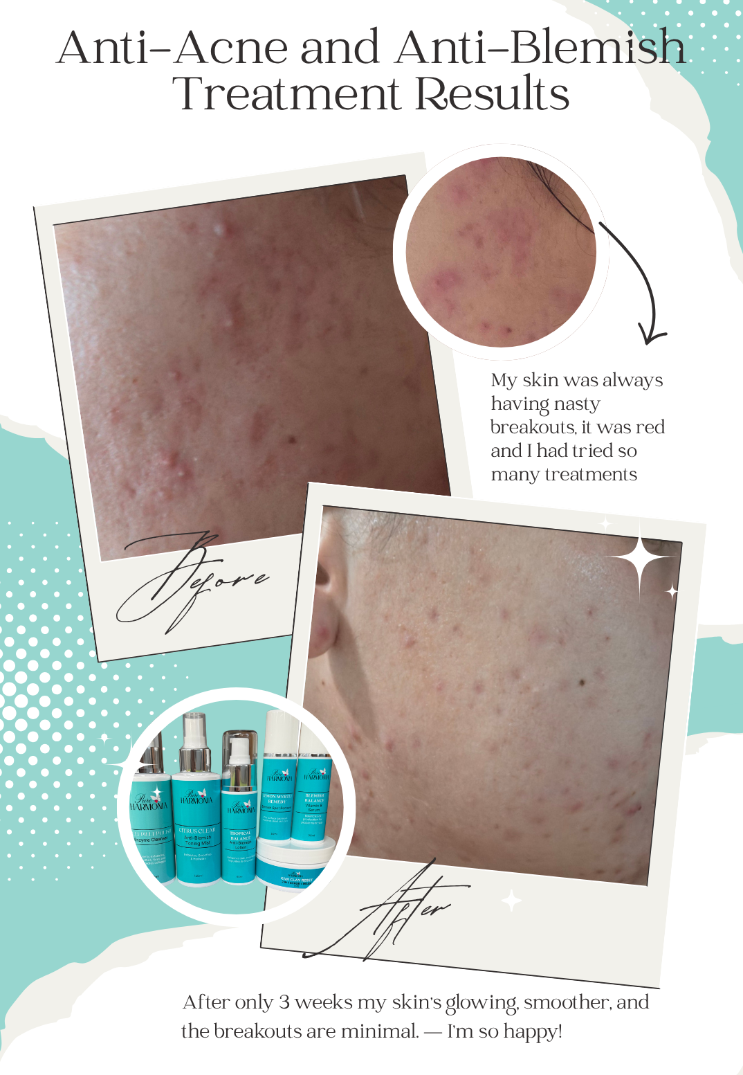 ESSENTIALS PACK - Acne and Blemish-Prone Skin Collection lifestyle detail - Pure Harmonia