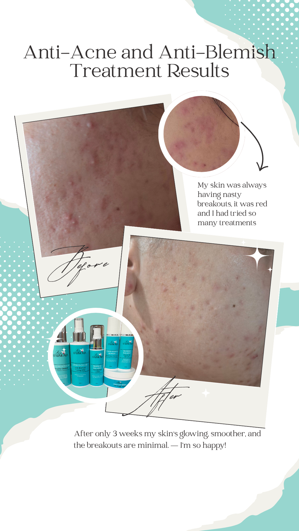 ESSENTIALS PACK - Acne and Blemish-Prone Skin Collection
