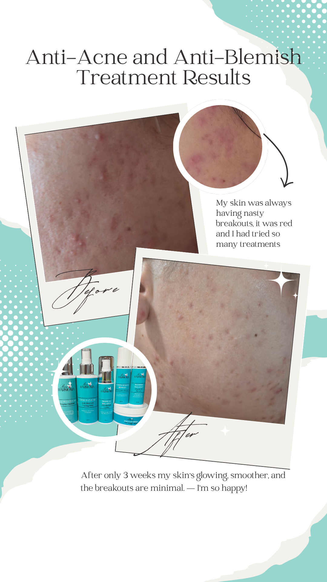 ESSENTIALS PACK - Acne and Blemish-Prone Skin Collection